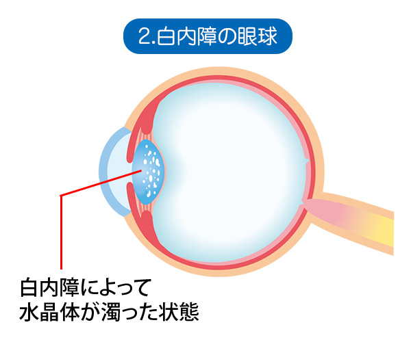 2．白内障の眼球