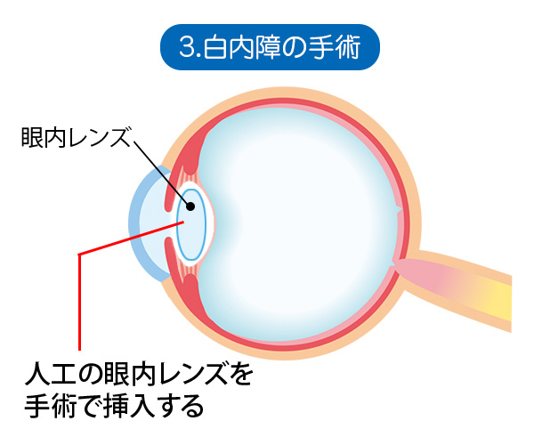 3．白内障の手術